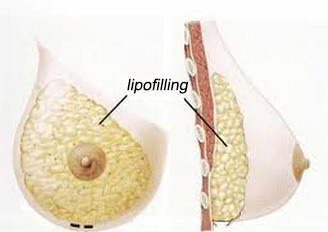lipofilling-mammaire-tunisie