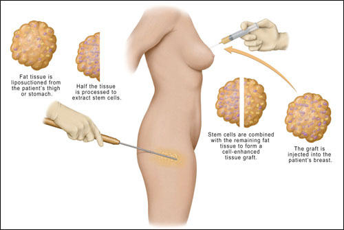 lipofilling-seins-tunisie