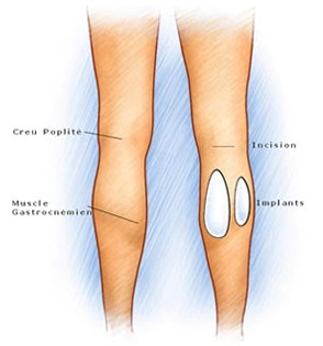 augmentation-mollets-par-protheses-tunisie