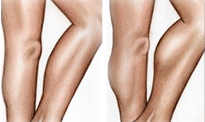 chirurgie-mollets-en-tunisie