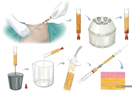 techniques-lipofilling-mollets-tunisie