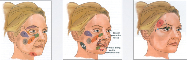 technique-lipofilling-visage