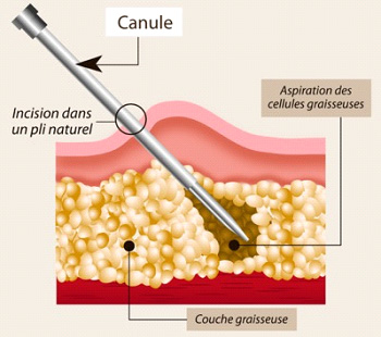 lipoaspiration tunisie