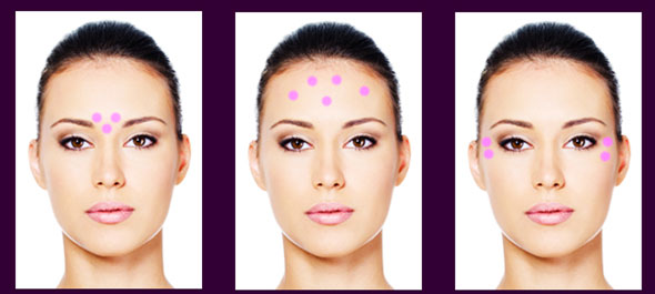 zones-injections-botox