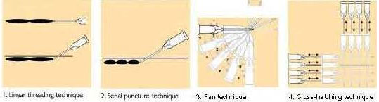 technique-injection-acide-hyaluronique