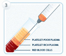 seance-prp-extraction