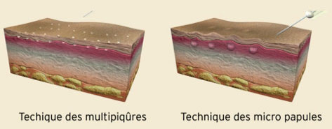 techniques-injections-prp-tunisie