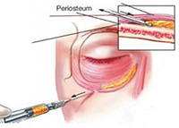 lipofilling-cernes-tunisie