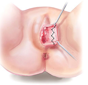 /nymphoplastie-technique-resection-longitudinale