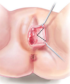 nymphoplastie-technique-resection-triangulaire-V