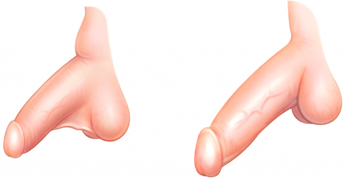 chirurgie-augmentation-penis-tunisie