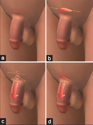 chirurgie-allongement-penis-tunisie